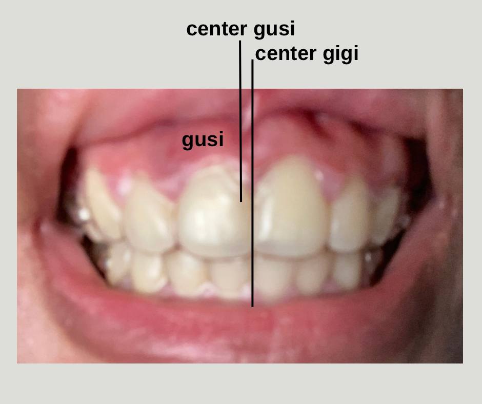 Baca Ini Sebelum Memutuskan Perawatan Gigi dengan Aligner RATA ...